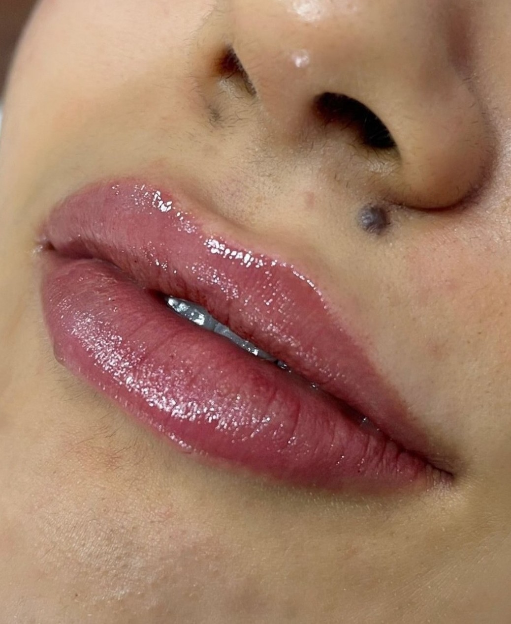 Depois do Preenchimento Labial