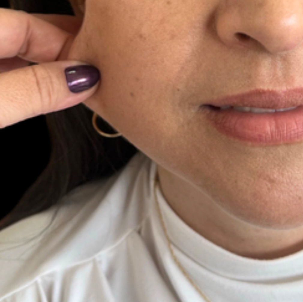 Depois do Ultrassom Microfocado